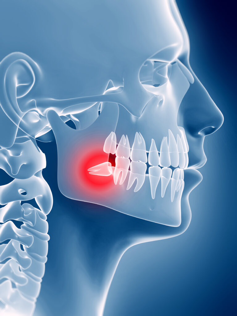 Photo showing an impacted tooth, specifically an impacted wisdom tooth